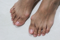 Relieving the Discomfort of Bunions