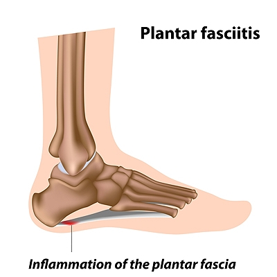 Inflamed sole of foot 2025