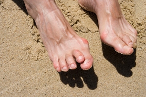 Hammertoe and Mallet Toe Differences