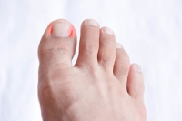 Cellulitis and Your Toenails
